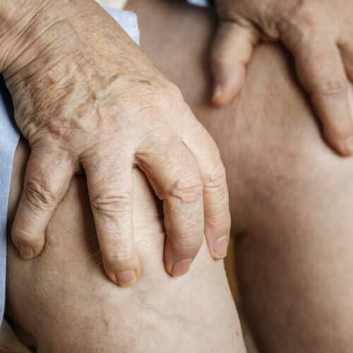 artrosi, gonartrosi, artrosi al ginocchio, ginocchio, dolore, fisioterapia