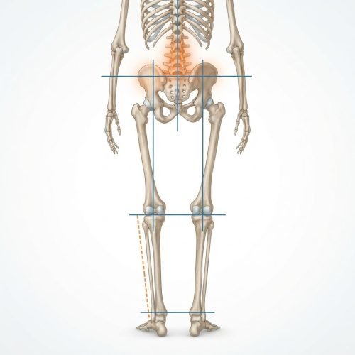 Arto più corto o bacino ruotato: anatomia del bacino e asimmetria degli arti
